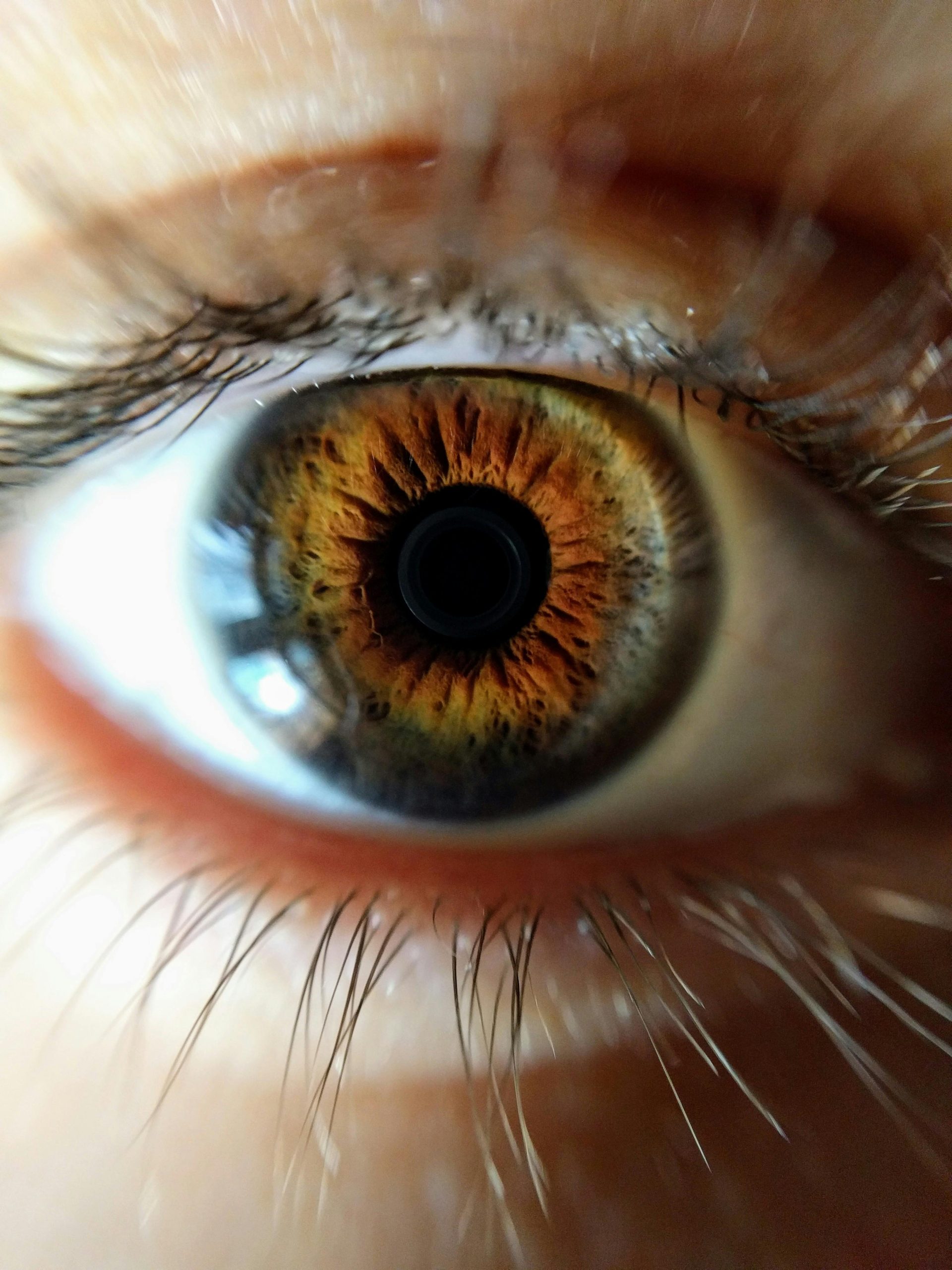 Why Lasik Turkey Price Attracts Thousands of Global Patients